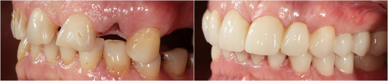 Sanierung der Mundhöhle, Vorbereitung für die ästhetische Prothetik. Installation von Implantaten.