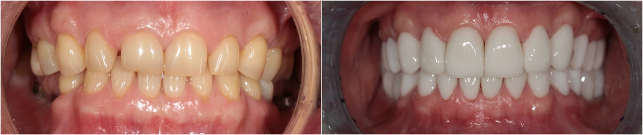 Komplette Rekonstruktion des Oberkiefers.  Implantation. Zirkoniumkronen und Brücken an Zähnen und Implantaten.