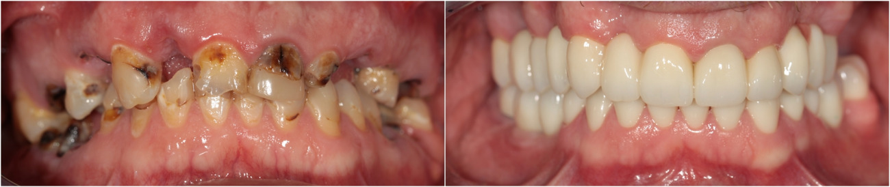 Komplette Rekonstruktion des Ober- und Unterkiefers.  Zirkoniumkronen und Brücken auf ihren Zähnen. Verschraubte Kronen auf Implantaten.