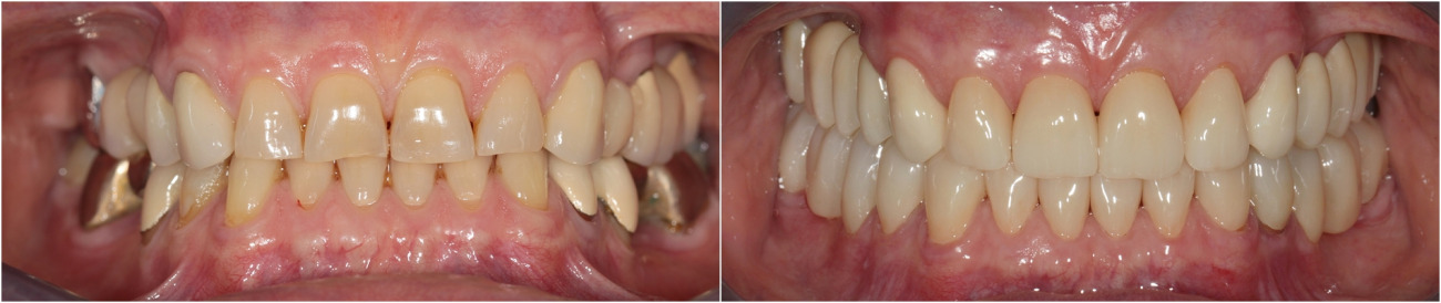 Umfassende Zahnprothetik. Wiederherstellung der Höhe eines Bisses. Zirkonoxidkronen und Brücken.
