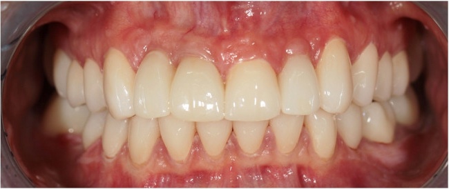 3D-Planung. Herstellung und Befestigung von Kronen und Veneers an allen Zähnen aus Zirkoniumdioxid.