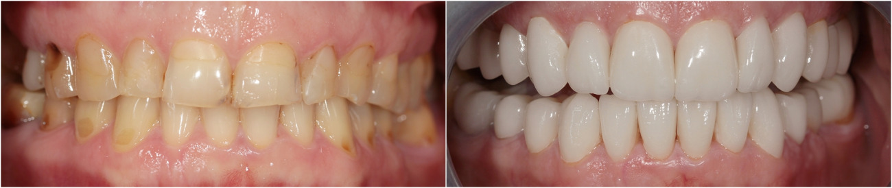 Complex prosthetic. Ceramic veneers. Ceramic crowns in the lateral areas.
