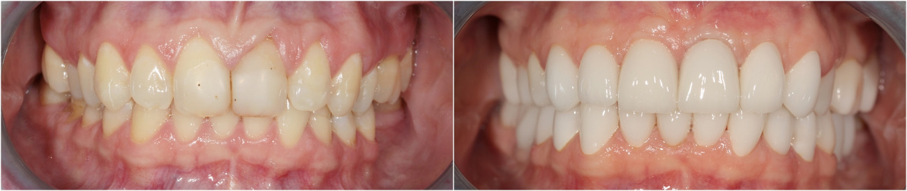 Changing of the all old fillings. Installation of implants. Complex prosthetics with ceramic veneers.
