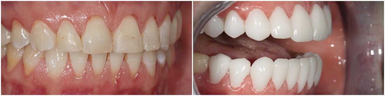 Ceramic veneers BLEACH by technologies CEREC one jaw in one day