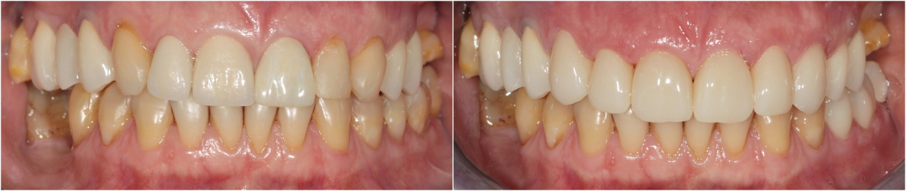 Fabrication and fixation the zirconium crowns and bridges on upper jaw.