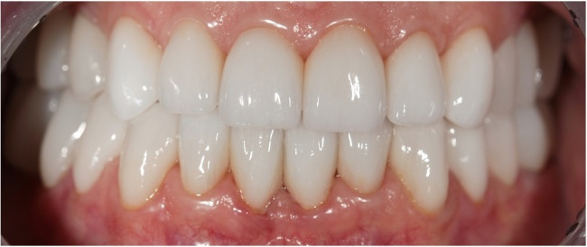 Complex prosthetic with ceramic veneers by technologies CEREC in the frontal teeth. Zirconium crowns and bridges in the lateral teeth.
