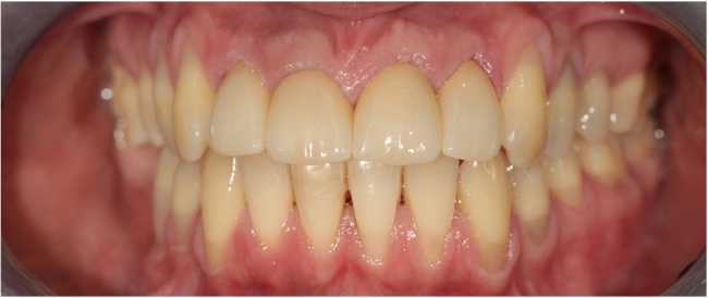 Dental hygiene. Endodontic retreatment. Build up of teeth. Changing of old fillings. Zirconium crowns.