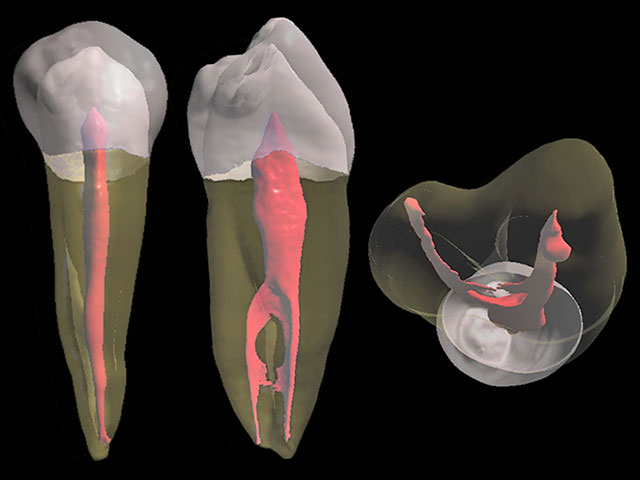 Root canal treatment in Prague